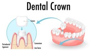 What is a Dental Crown